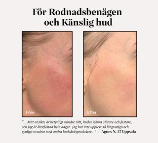 Bild på Rodnadsbenägen & Känslig hud